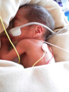 NICU　lala♪　低出生体重　胎児発育不全　リトルベイビー