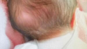 NICU　赤ちゃん　頭　長い　斜頭症